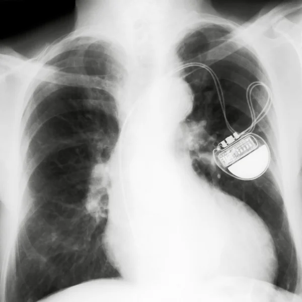 X-rayed chest — Stock Photo, Image