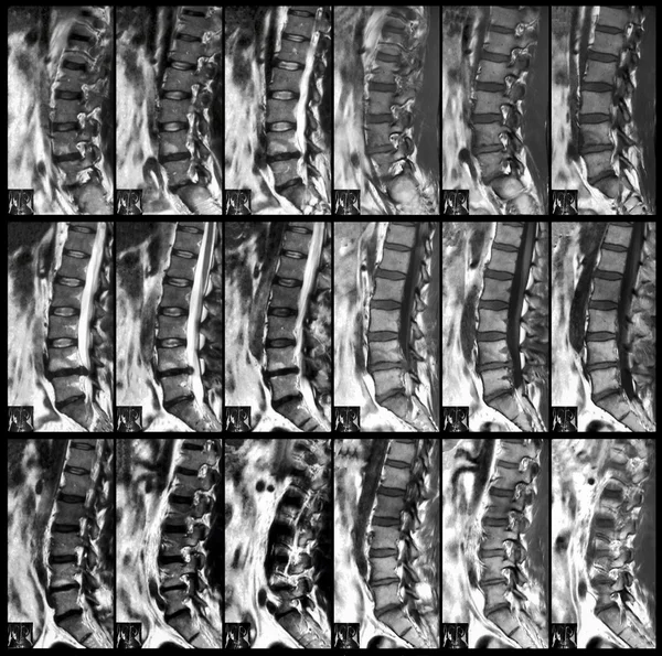 Röntgenstrahl der Wirbelsäule — Stockfoto
