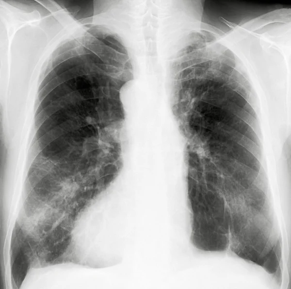 Pulmones de rayos X —  Fotos de Stock