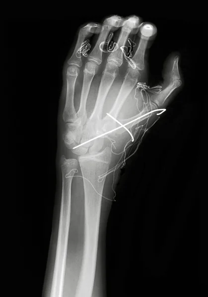Рентгеновское изображение руки — стоковое фото