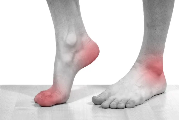 Disease of the feet — Stock Photo, Image