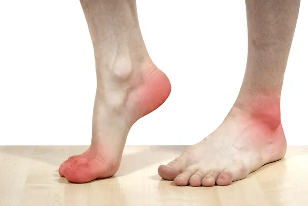 Izolované onemocnění nohou — Stock fotografie
