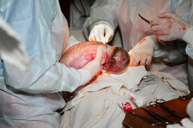 Baby being born during cesarean section clipart