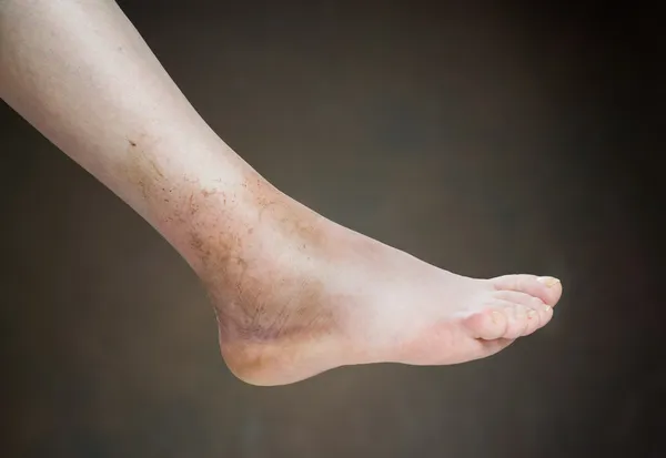 Ankle sprain — Stock Photo, Image