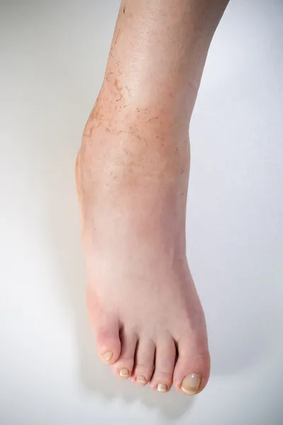 Ankle sprain — Stock Photo, Image
