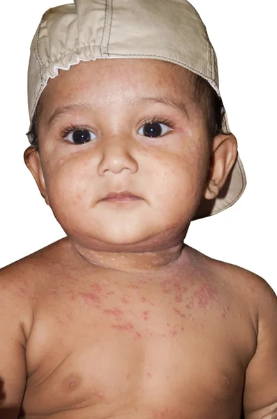 Small baby with skin rashes — Stock Photo, Image