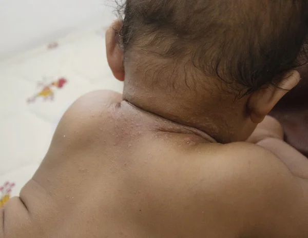 Infección de la piel del bebé —  Fotos de Stock
