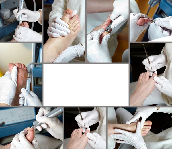 Cura del piede nel processo - Collage fotografico — Foto Stock