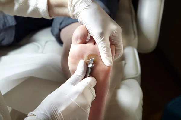 A Pedicurist works with a scalpel — Stock Photo, Image