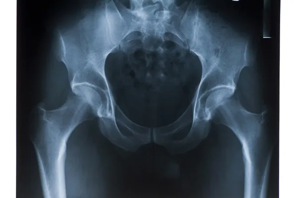 Röntgenaufnahme des Beckens — Stockfoto