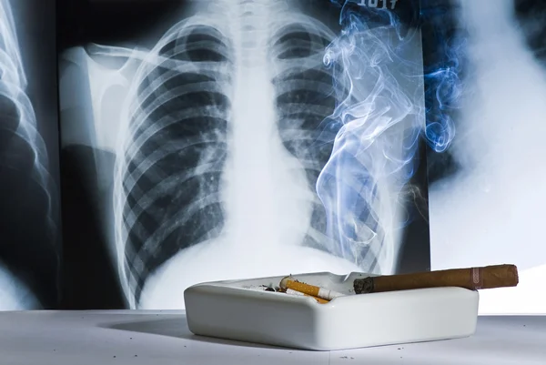 Radiografia e cigarros — Fotografia de Stock
