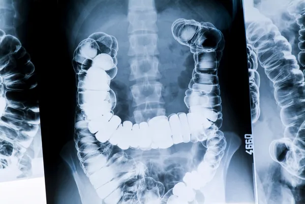 Radiografia do intestino — Fotografia de Stock