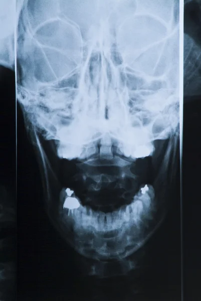 Röntgen des Kopfes und der Zähne — Stockfoto