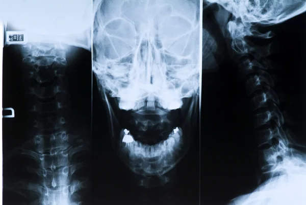 Radiografie hlavy a krku — Stock fotografie