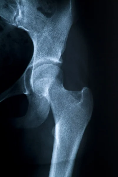 Röntgenaufnahme des Oberschenkelknochens — Stockfoto