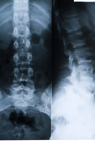 Röntgenbilder der Wirbelsäule — Stockfoto