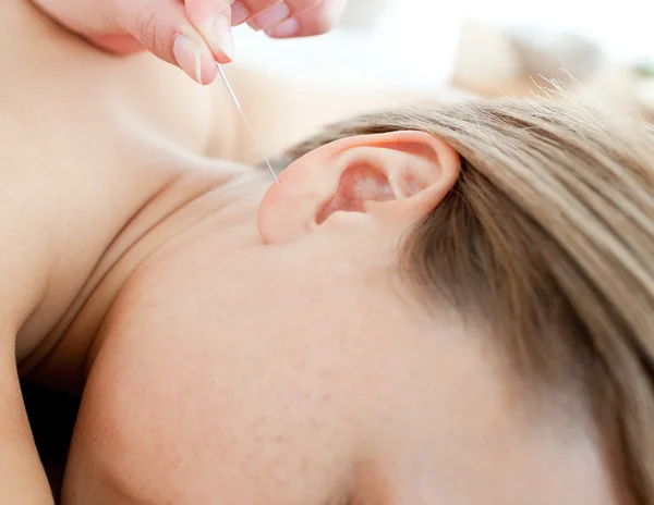 Igły do akupunktury na ucho mlodej kobiety — Zdjęcie stockowe