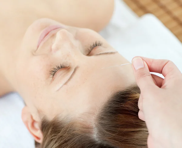 Agulhas de acupuntura na cabeça de uma mulher atraente — Fotografia de Stock