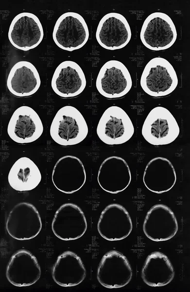 X-ray of the brain computed tomography — Stock Photo, Image