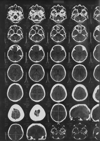 大脑的 x 射线图像 — 图库照片