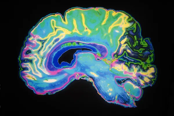 Resonancia magnética coloreada del cerebro humano — Foto de Stock