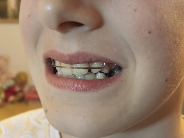 Diş düzeltme aparatı — Stok fotoğraf