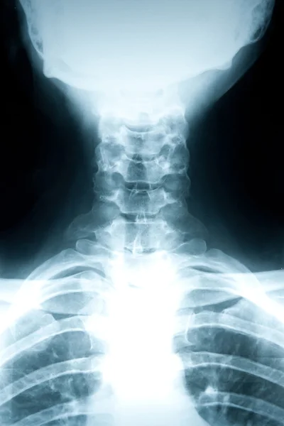颈部损伤 — 图库照片