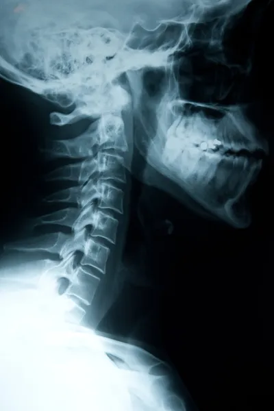 Lesioni al collo — Foto Stock