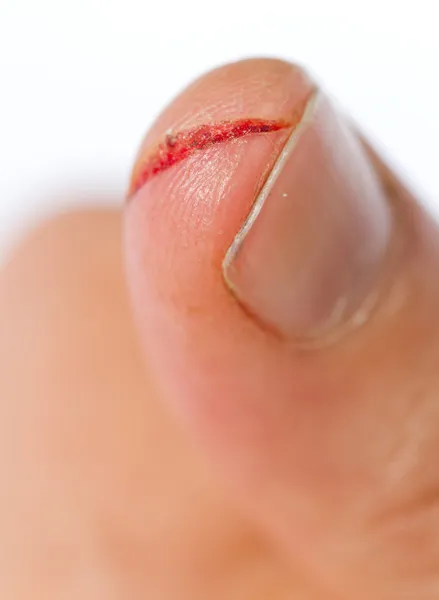Поврежденный палец — стоковое фото