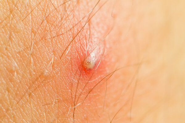 Pimple Extreme Macro