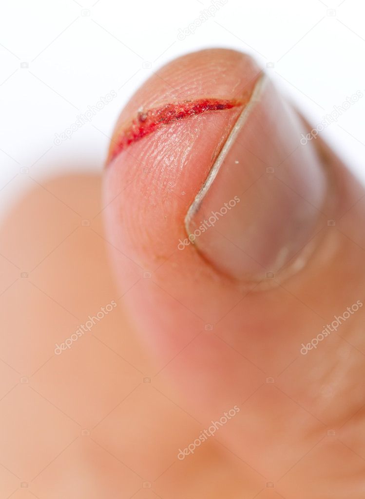 Injured finger