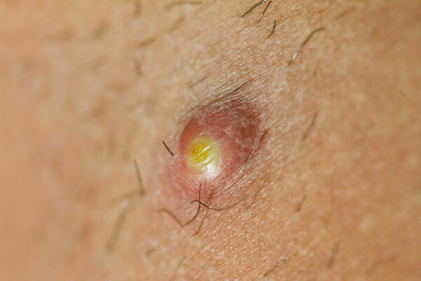 Pimple Extreme Macro