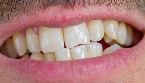 Homme caucasien dents — Photo