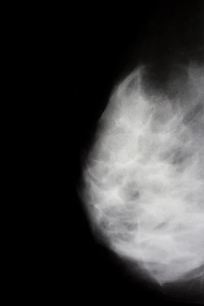 Женский рентген груди — стоковое фото