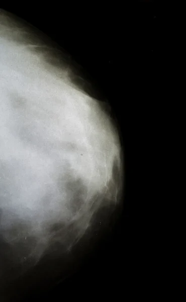 Женский рентген груди — стоковое фото