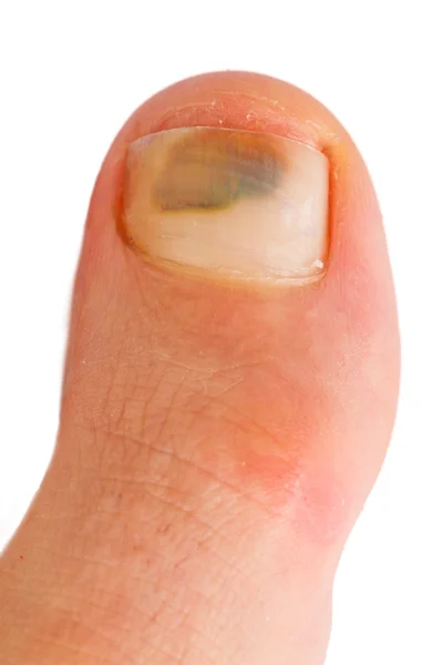 Big toe — Stock Photo, Image