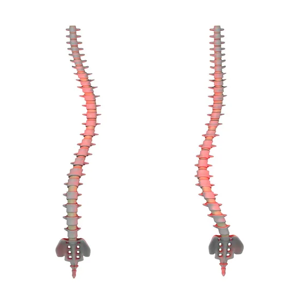 Scoliosi spinale — Foto Stock