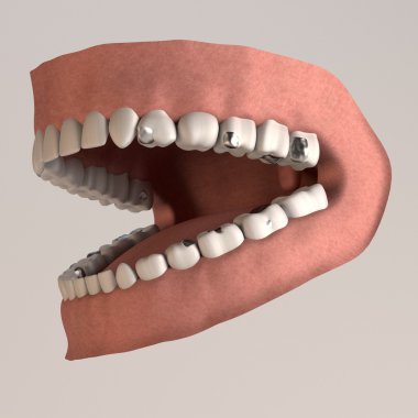 3d render of human teeth with fillings clipart