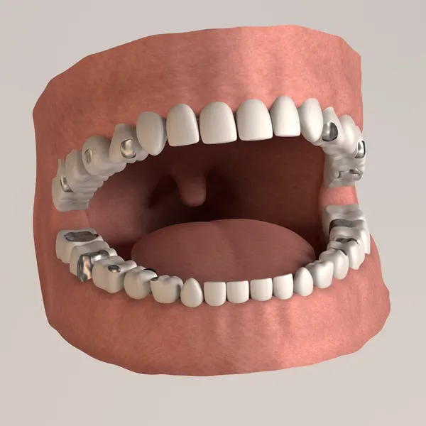 3d render of human teeth with fillings — Stock Photo, Image
