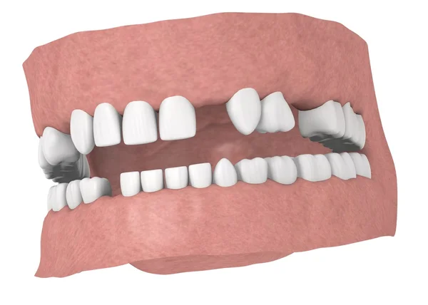 Rendering 3d di denti umani senza alcuni denti — Foto Stock