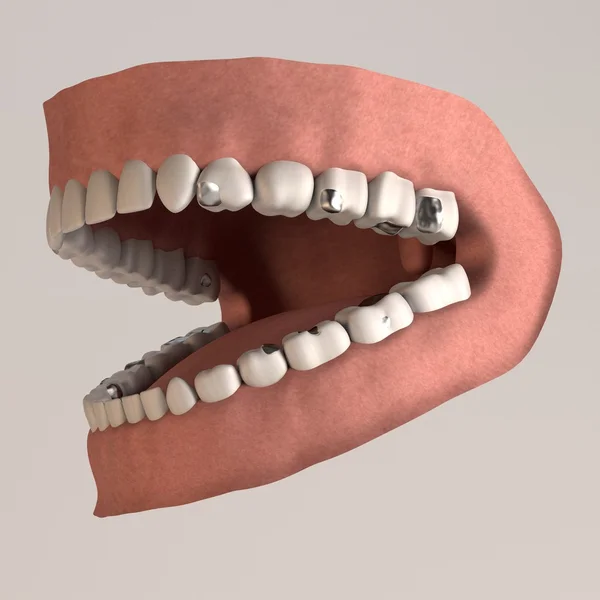 Rendering 3d di denti umani con otturazioni — Foto Stock