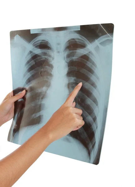 Röntgenbild eines menschlichen Brustkorbs. — Stockfoto