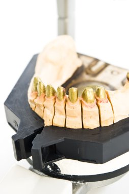 Metal dental mold