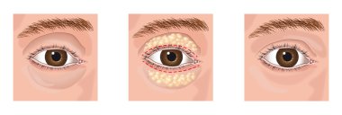 Blepharoplasty clipart