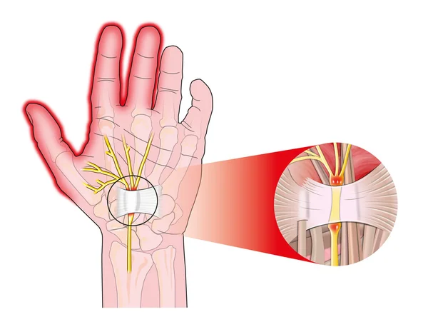Transverse carpal ligament — Stock Vector