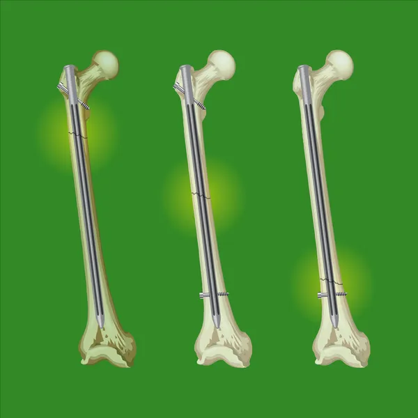 大腿骨骨折 — ストックベクタ
