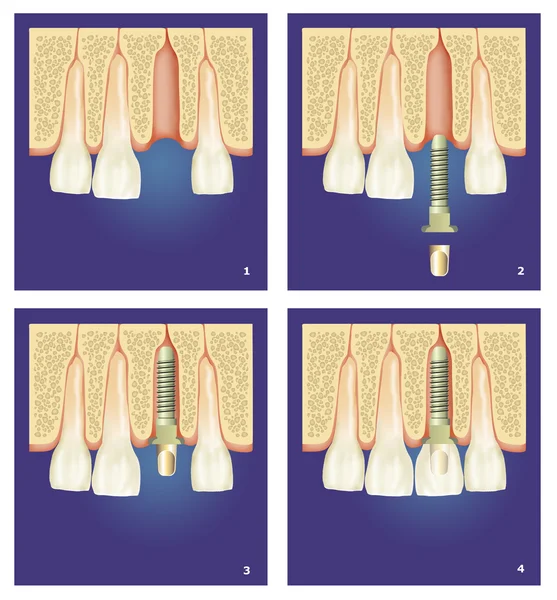 Protesi dentale — Zdjęcie stockowe