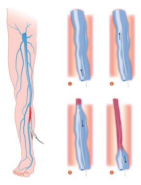 Varicose_veins clipart