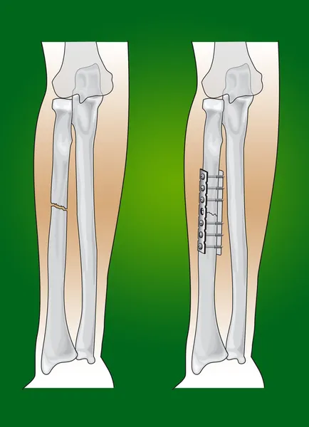 Fractura de radio — Vector de stock