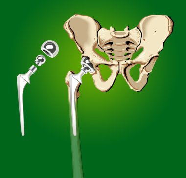 Prosthesis of the hip clipart